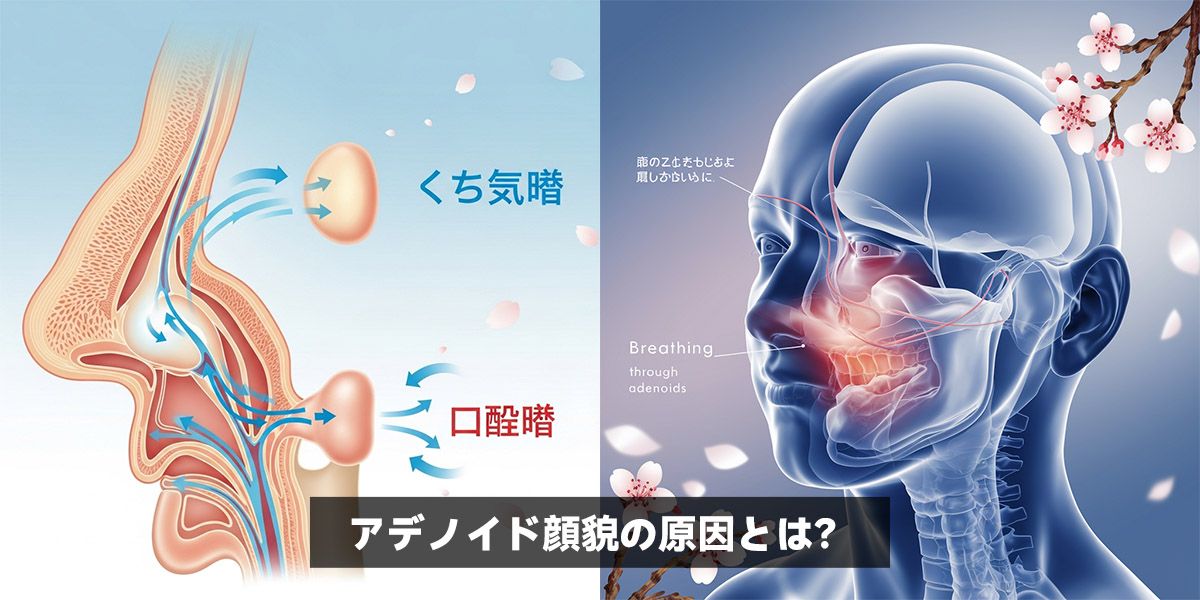 アデノイド顔貌の原因とは？